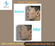 Acne Treatment Clinic In Edmonton,  Acne treatment clinic | Oxyderm
